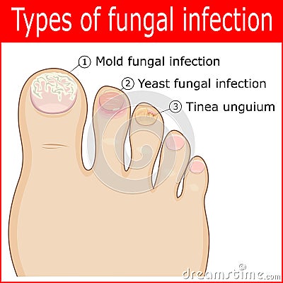 Types of fungal infections Vector Illustration