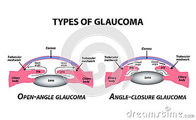 Types of glaucoma. Open-angle and angle-closure glaucoma. The anatomical structure of the eye. Infographics. Vector Vector Illustration