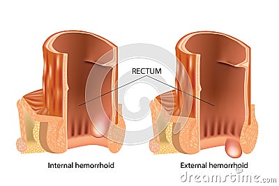 Types of Hemorrhoids. Hemorrhoids, also called piles Vector Illustration