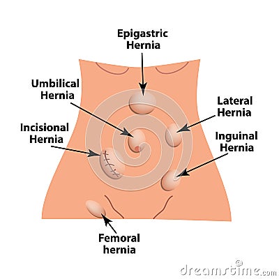 Types of hernia. Epigastric, Lateral, Umbilical, Inguinal, femoral, incisional hernia. intestinal hernia. Infographics. Vector Vector Illustration