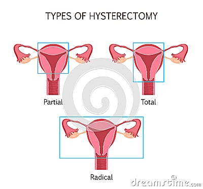 Types of Hysterectomy Vector Illustration