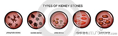 Types of kidney stones Vector Illustration
