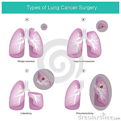 Types of Lung Cancer Surgery. Illustration. Vector Illustration