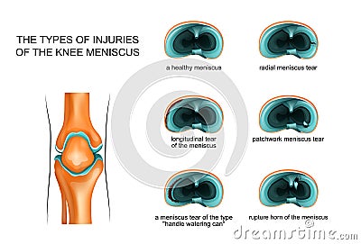 Types of meniscus tear Vector Illustration