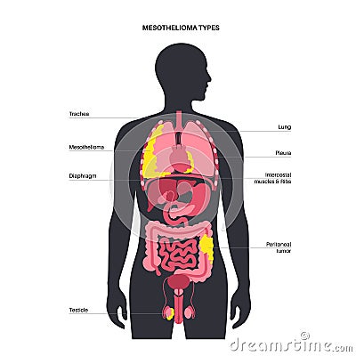 Mesothelioma tumor types Vector Illustration
