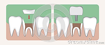 Types of Microprosthesis and Tooth Implantation, Flat Vector Stock Illustration or Collage with Ceramic Crown or Inlay Cartoon Illustration