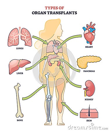 Types of organ transplants and inner body parts replacement outline diagram Vector Illustration