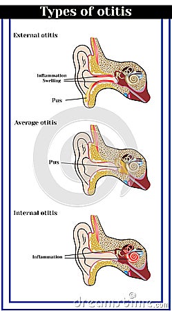 Types of otitis : external, average and internal otitis. Vector Illustration