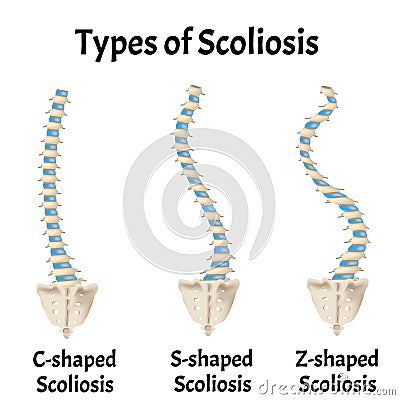 Types of Scoliosis. C, S, Z shaped scoliosis. Dextroscoliosis. Levoscoliosis. Spinal curvature, kyphosis, lordosis Vector Illustration