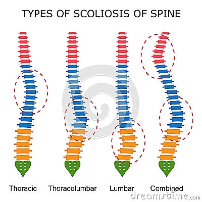 Types of scoliosis of spine. Vector Illustration