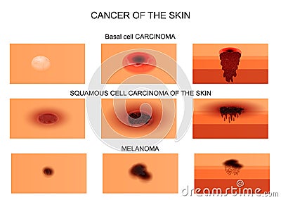 Types of skin cancer. Vector Illustration