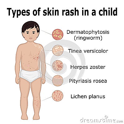 Types of skin rash in a child Vector Illustration