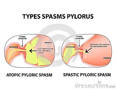Types of spasms of the pylorus. Pylorospasm. Spastic and atonic. Pyloric sphincter of the stomach. Infographics. Vector Vector Illustration