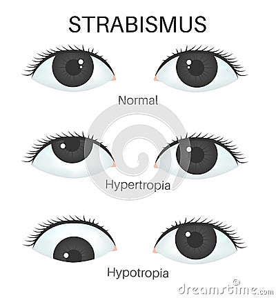 Types of strabismus-1 Vector Illustration