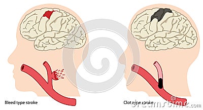 Types of stroke Vector Illustration