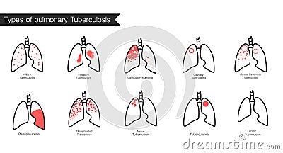 Types of tuberculosis. Vector silhouette medical illustration of human body organ lungs with trachea. Poster for clinic, hospital Vector Illustration