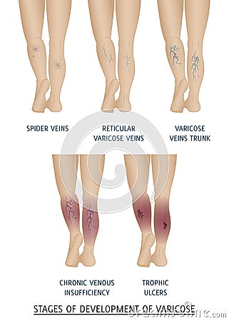Types of varicose veins in women. Stages of development of varicose veins, vector illustration. Vector Illustration