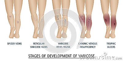 Types of varicose veins in women. Vector Illustration