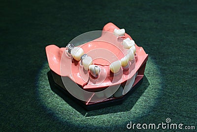 Typodont plastic moulage of human jaws demonstrating dental braces on teeth Stock Photo