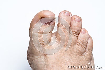 Ugly, Dirty, Weird toes. Close up on white background Stock Photo