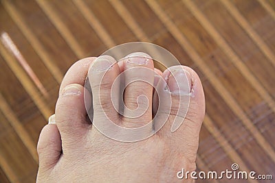 Ugly feet Stock Photo