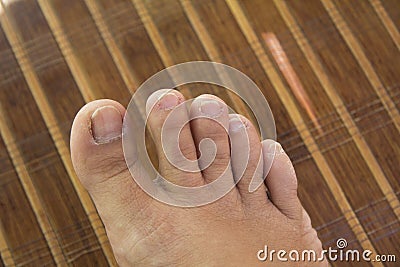 Ugly foot Stock Photo