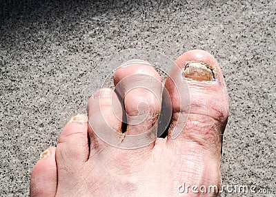 Ugly male feet and toes affected by toe nail fungus and arhtritic hammertoes Stock Photo