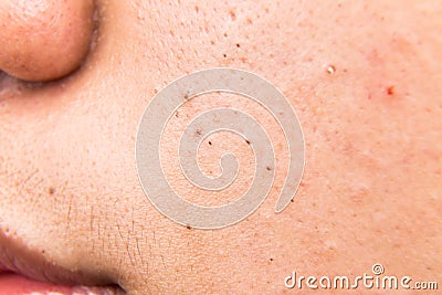 Ugly pimples, acne, zit and blackheads on the cheek of a teenager Stock Photo