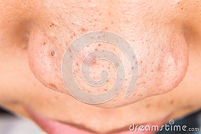 Ugly pimples, acne, zit and blackheads on the nose of a teenager Stock Photo