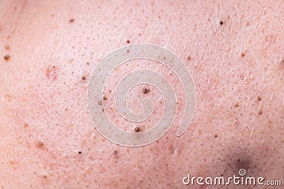 Ugly pimples blackheads on face of teenager Stock Photo