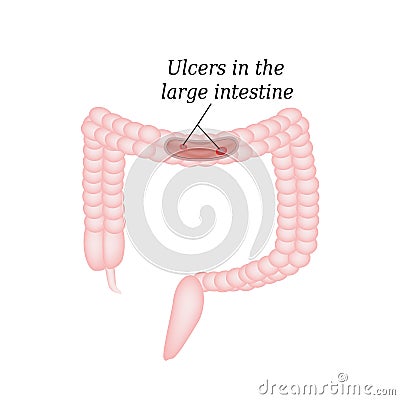 Ulcer in the intestine. Ulcers in the colon Vector Illustration