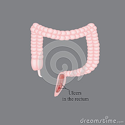 An ulcer in the rectum. Ulcers in the intestines Vector Illustration