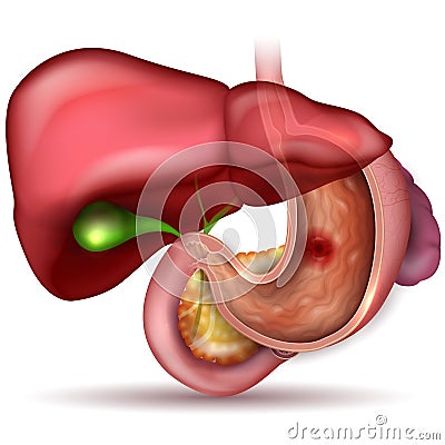 Ulcer Vector Illustration