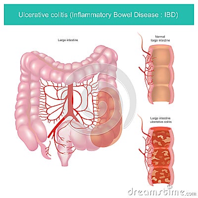 Ulcerative colitis. Illustration graphic. Vector Illustration