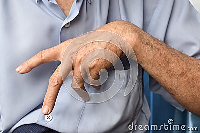 Ulnar claw hand of Asian elder man. also known as & x27;spinster& x27;s claw Stock Photo