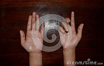 Ulnar claw hand of Asian young woman. also known as `spinster`s claw Stock Photo