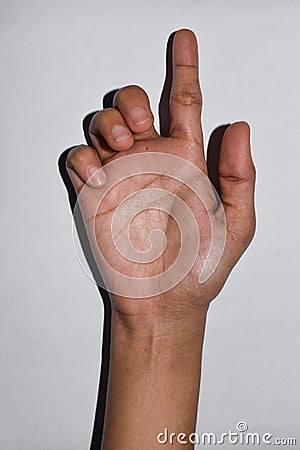 Ulnar claw hand of Asian young woman. also known as `spinster`s claw Stock Photo