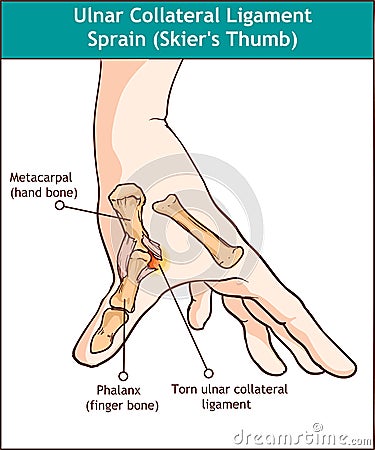 Ulnar Collateral Ligament Sprain Skier`s Thumb Vector Illustration
