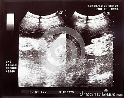 Ultrasonic result of the fetus and cardiogram of the baby Stock Photo
