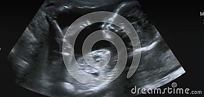 Ultrasonography Analysis of a 4th Month Fetus Stock Photo