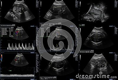 Ultrasonography fetus pictures Stock Photo