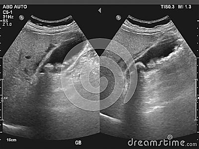 Ultrasonography image of gallbladder with gall stones at upper abdomen Stock Photo