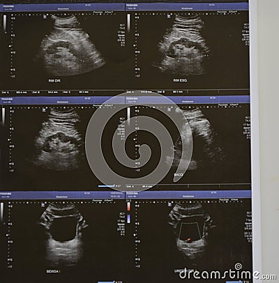 Ultrasonography of the upper abdomen with visualized portions of various organs Stock Photo