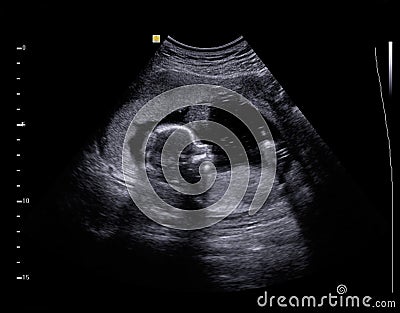 Ultrasound Baby Stock Photo