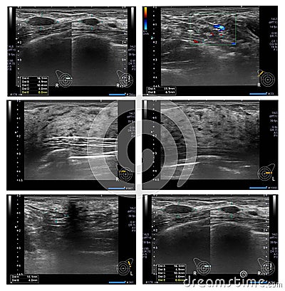 Ultrasound Breast a Female 34 year old Stock Photo