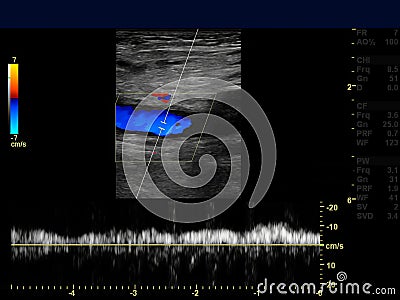 Ultrasound doppler of femoral vien. Stock Photo