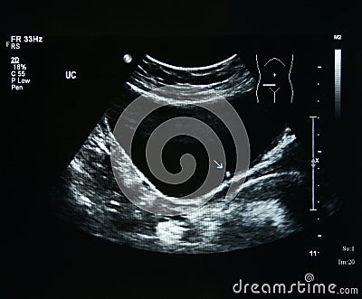 Ultrasound film of a woman kidney abnormal Stock Photo