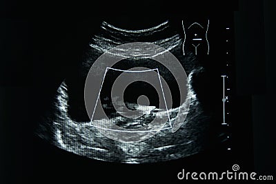 Ultrasound film of a woman left ureter abnormal Stock Photo