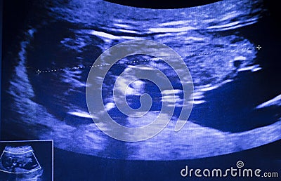 Ultrasound foetus pregnancy scan Stock Photo