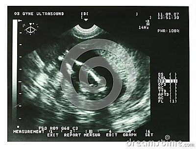 Ultrasound image Stock Photo